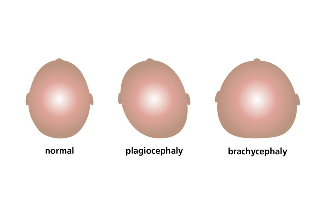 A diagram showing the the different types of flattening babies' heads can undergo.