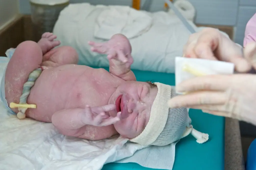 A newborn baby with its umbilical cord clamped